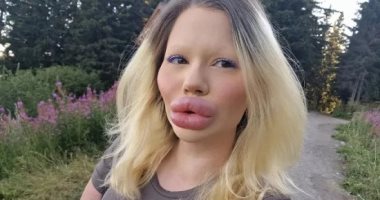 بلغارية خضعت لـ32 حقنة لتحصل على لقب صاحبة أكبر شفاه فى العالم.. صور