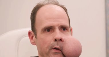 قصة رجل يعيش بورم يزن 2 كجم فى وجهه وينتظر مساعدة الأطباء