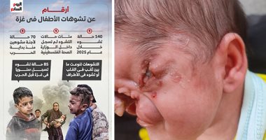 أجساد محفورة بالذخائر.. تشوهات أطفال غزة بين بقايا الحرب وجرح التنمر.. عجز الأطباء وانهيار المنظومة الصحية آلام تتكلم.. أطفال يصرخون: نتمنى أن نعود جميلات مثلما كنا.. والأسلحة المحرمة السبب الأول بانتشار الأزمة