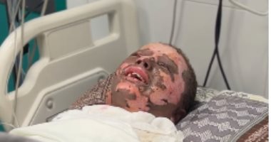 "أنا المهندس".. مجد أبو حبيب حلم طفولة احترق في رماد العدوان.. لهيب مخلفات الحرب يلتهم براءة الطفل الفلسطيني ويحرق جسده.. والدته: ابنى موهوب ودائما يحب الاختراعات وجسم مشبوه حرق 40% من جسده.. صور وفيديو