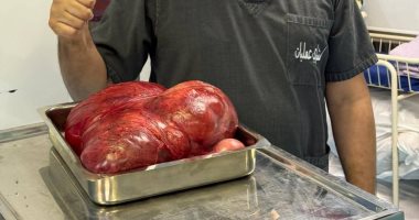 استئصال ورم يزن 8 كيلوجرامات من سيدة بمستشفىي المنصورة التخصصي