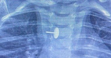 فريق جراحى بالقليوبية يستخرج «دبوس» من مرئ طفلة ابتلعته منذ 6 أشهر