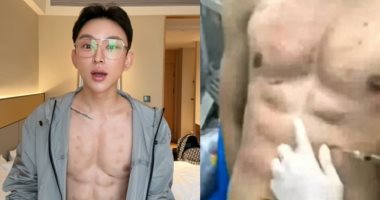 مؤثر صينى ينفق 560 ألف دولار للحصول على عضلات بطن وهمية بحقن الهيالورونيك