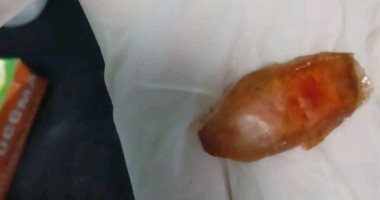 مستشفى بالشرقية ينقذ رضيعا عمره 45 يوما تعرض لتوقف القلب بعد ابتلاع بلحة