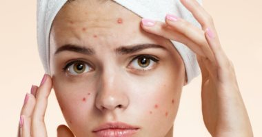  طرق طبيعية بسيطة للتخلص من حب الشباب.. أبرزها الليمون والعسل