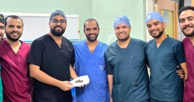 استخراج 58 حصوة من كلية مريض داخل مستشفى قنا الجامعى  