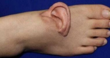 امرأة صينية تعيد تثبيت أذنها بعد 5 أشهر من زراعتها فى باطن قدمها