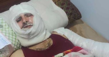 واقعة إصابة مواطن بحروق