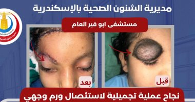 نجاح عملية تجميلية لإزالة ورم ملون ومشعر من وجه طفلة بمستشفى أبوقير العام