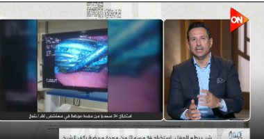 حفلة مسامير فى كفر الشيخ.. فريق طبي ينجح في استخراج 34 مسماراً من معدة مريضة