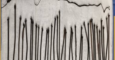 بدون تدخل جراحى.. استخراج 34 مسمارا من معدة مريضة بمستشفى كفر الشيخ العام