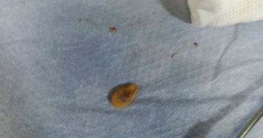 استخراج حبة لب من الشعب الهوائية لطفل بمستشفى الأطفال التخصصى فى بنها