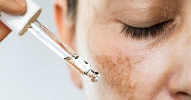 وصفات طبيعية سهلة للتخلص من البقع الداكنة الناتجة عن حب الشباب 