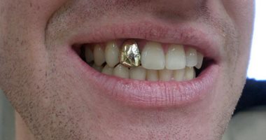ما حكم حشو الأسنان بالذهب؟.. الإفتاء توضح