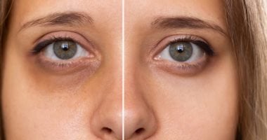 وصفات طبيعية للتخلص من الهالات السوداء 