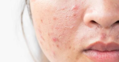 وصفات طبيعية للتخلص من ندبات حب الشباب.. من خل التفاح لعصير الليمون