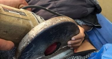 فريق طبى ينجح فى استخراج منشار كهربى استقر فى بطن طفل بدمياط
