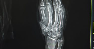 إنقاذ شاب من بتر كامل بإصبع الإبهام بمستشفى سوهاج الجامعي