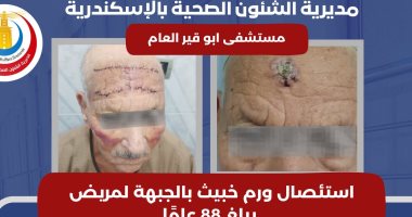 نحاح عمليتى استئصال ورم خبيث بالجبهة بمستشفى أبو قير العام