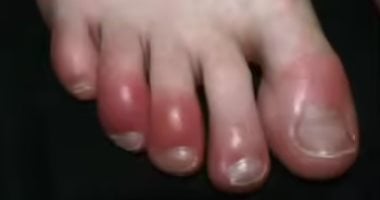 لماذا يصيب التورم والاحمرار أصابع القدمين فى الشتاء؟ وطرق العلاج