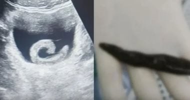 علاج شعبى مضلل يقود شابا صينيا إلى الطوارئ بعد إدخال علقة حية فى المثانة