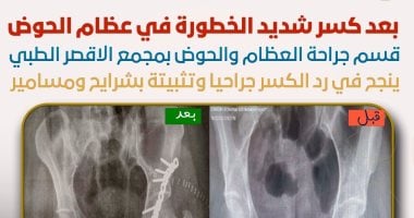 أطباء مجمع الأقصر الطبي ينجحون فى رد مفتوح لكسر خطير بعظام الحوض لمواطن
