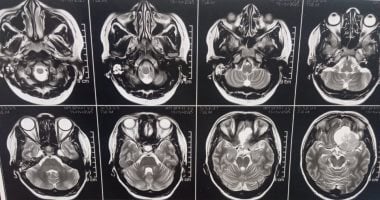 استئصال ورم ضخم بقاع الجمجمة لمريضة بمستشفى سوهاج الجامعى