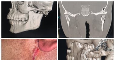 مستشفى شربين بالدقهلية يحقق إنجازا جديدا فى جراحة الوجه والفكين