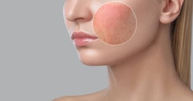 وصفات طبيعية لعلاج المسام المفتوحة.. أبرزها بياض البيض