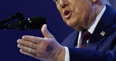 البيت الأبيض يكشف سبب كدمة على يد الرئيس الأمريكى ترامب فى دافوس.. صور
