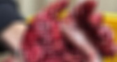 إنقاذ ذراع طفل بمستشفى طوارئ جامعة سوهاج بعد إصابة مروعة