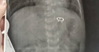 فريق جراحى بمستشفى ناصر التخصصى ينقذ رضيع عمره 14 يوماً من جسم غريب فى معدته