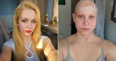 أطفالها لا يعرفونها دون الباروكة.. قصة أم فقدت فروة رأسها فى حادث عمل