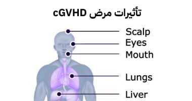ما بعد زراعة النخاع العظمي؟