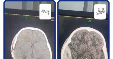 تدخل جراحي دقيق مرتين خلال 24 ساعة ينجح فى إنقاذ حياة طفل بمستشفى أجا المركزى