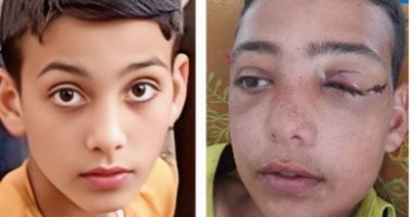 طفل غزة عبد الرحمن أبو جزر يفقد عينه وينتظر إجلاء عاجلا للعلاج خارج القطاع