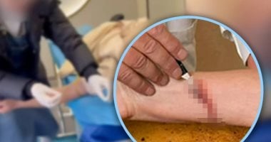 القبض على أطباء صينيين يدعون العلاج بالفصد «الإدماء» لإزالة الطاقة الشريرة