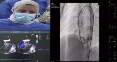 إجراء بث حى لقسطرتين قلبيتين تداخليتين لعيوب القلب الخلقية للأطفال بجامعة طنطا
