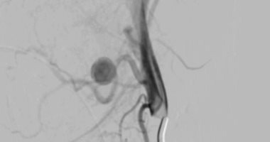 مستشفيات سوهاج الجامعية تنقذ حياة طفلة وتغلق تمددا شريانيا نازفا دون جراحة