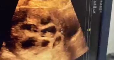 حالة استثنائية.. سيدة قنائية تحمل فى 8 توائم بعد 4 سنوات من حرمان الإنجاب 