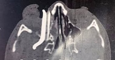 إنقاذ بصر طفل بعد جراحة معقدة لاستخراج جسم غريب بطول 10 سم من محجر العين بسوهاج