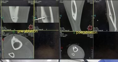 نجاح عملية كي حراري لعلاج ورم عظمي حميد بمستشفيات جامعة بنى سويف