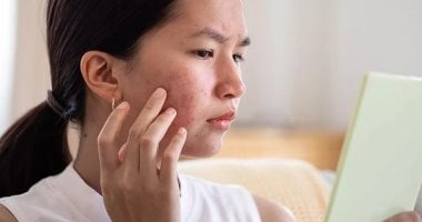 وصفات طبيعية للتخلص من حب الشباب.. خطواتها بسيطة ونتائجها مدهشة 