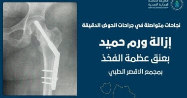 نجاح فريق العظام بمجمع الأقصر الطبى فى استئصال ورم حميد لسيدة فى الثلاثينات