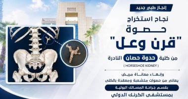 استخراج حصوة فى عملية جراحية نادرة لمواطن أربعيني بمستشفى الكرنك بالأقصر