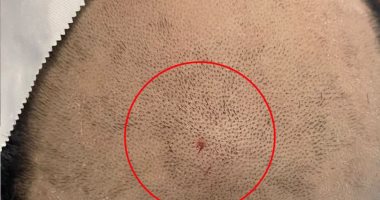 نجاح جراحة دقيقة لاستخراج مسمار ضغط هوائي من مخ طفل بالمنصورة