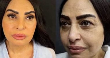 سلوى خطاب بعد عملية شد الوجه: كان عندى تكتلات دهنية فى وشى وشلتها