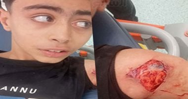 كلب ضال يعقر 6 أشخاص بينهم أطفال في مدينة بني عبيد بالدقهلية.. صور