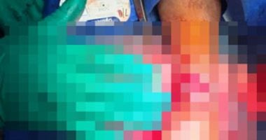 بعد 6 ساعات جراحة.. أطباء مستشفى أسوان الجامعي يعيدون يدًا مبتورة لمصاب