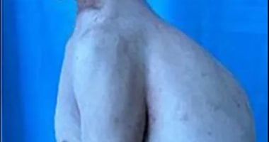 Chinese Doctors Remove Back Tumour Weighing About as Much as Three Newborns